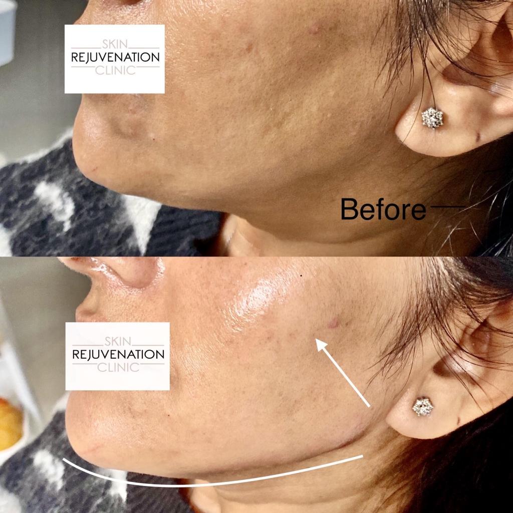Treatment result