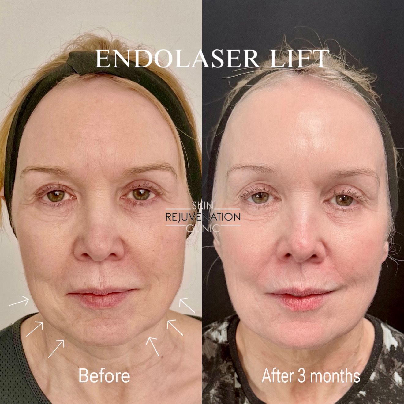 Endolaser Lift before and after 3 months, front view