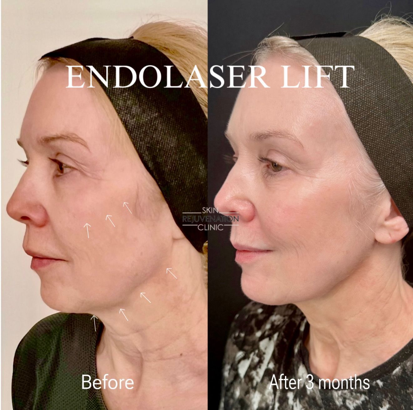 Endolaser Lift before and after 3 months, profile view