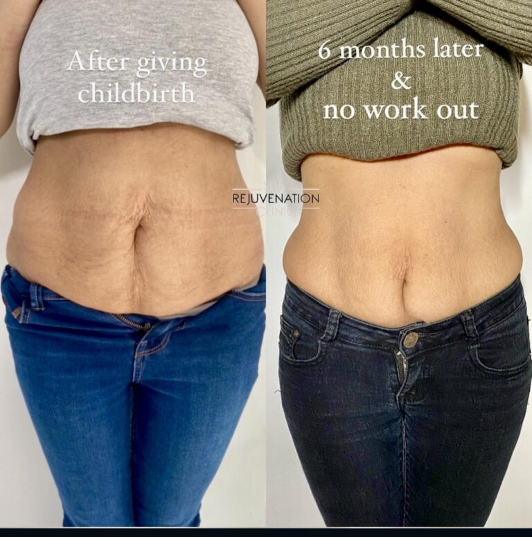 Treatment result