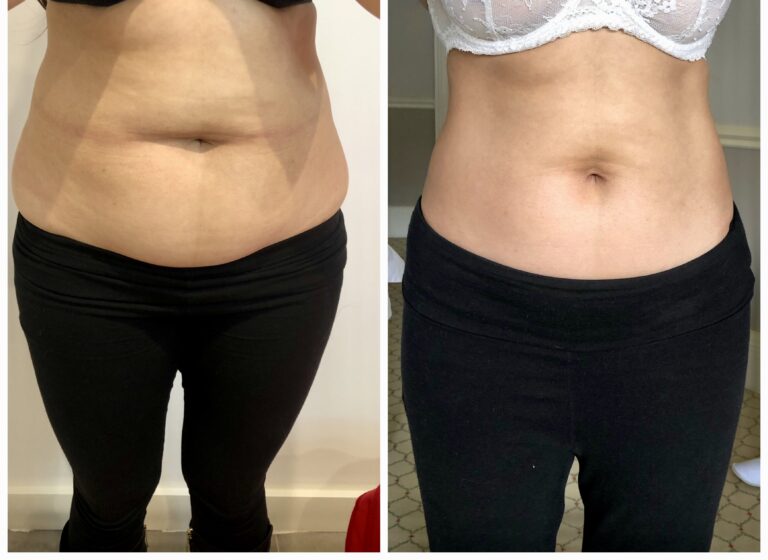 Treatment result