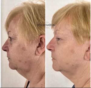 Treatment result