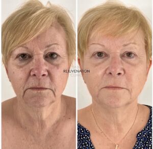 Treatment result