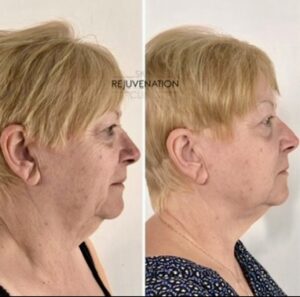 Treatment result