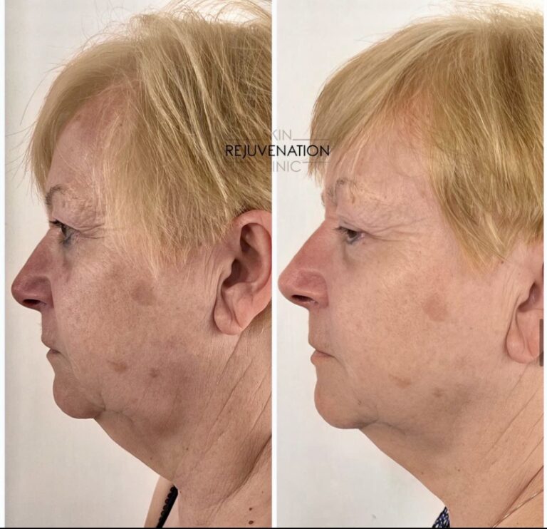Treatment result