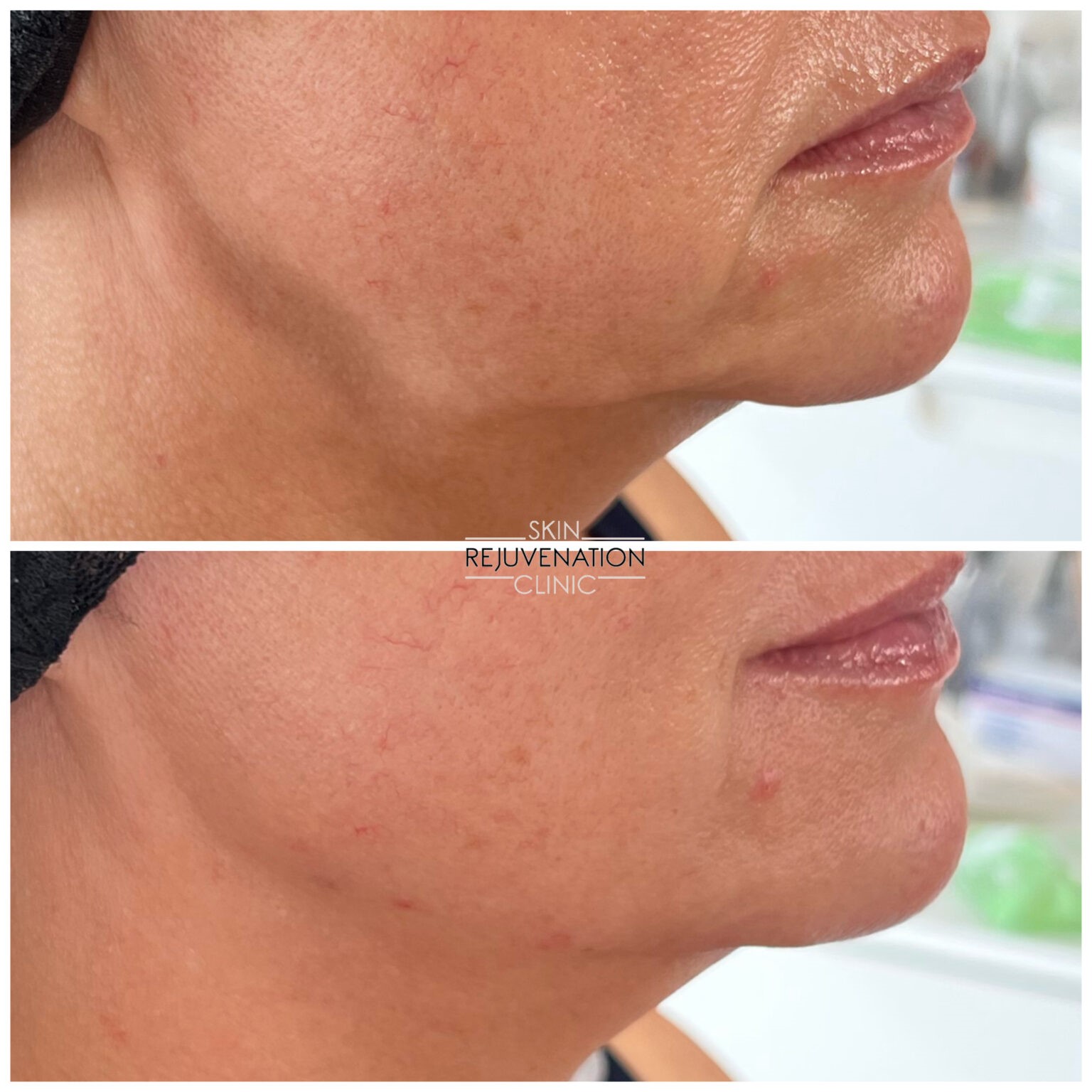 Treatment result