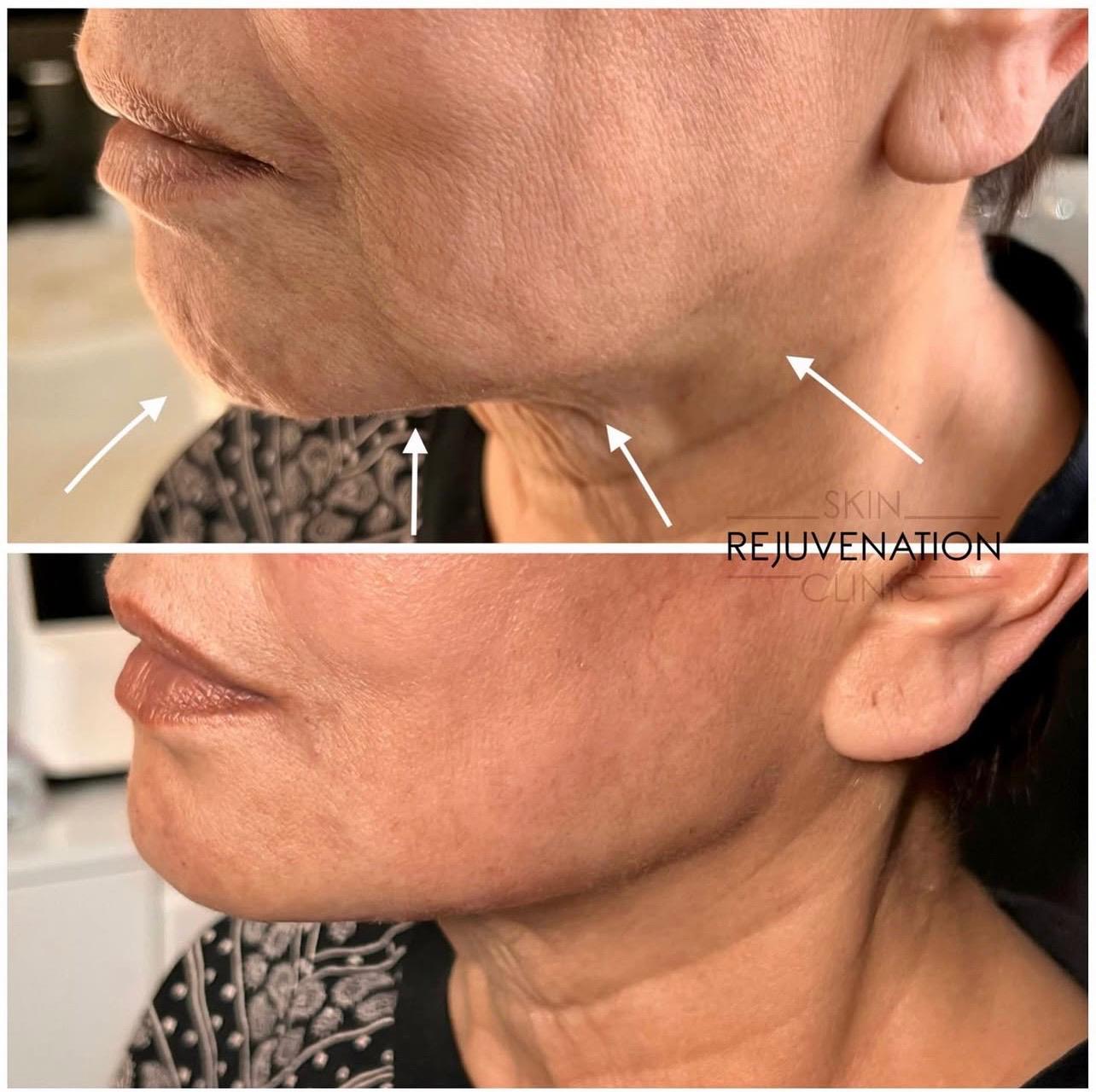 Treatment result