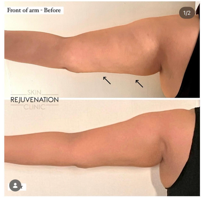 Treatment result