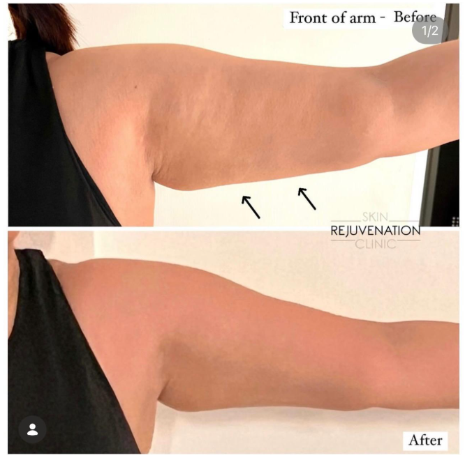 Treatment result