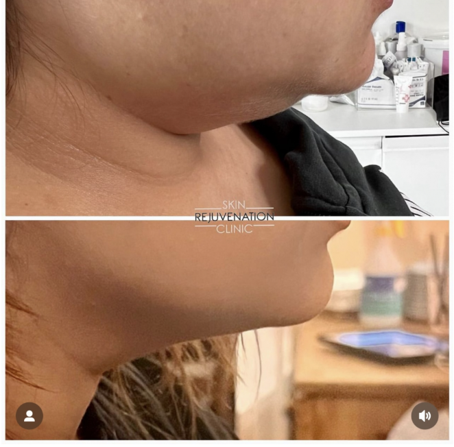 Treatment result