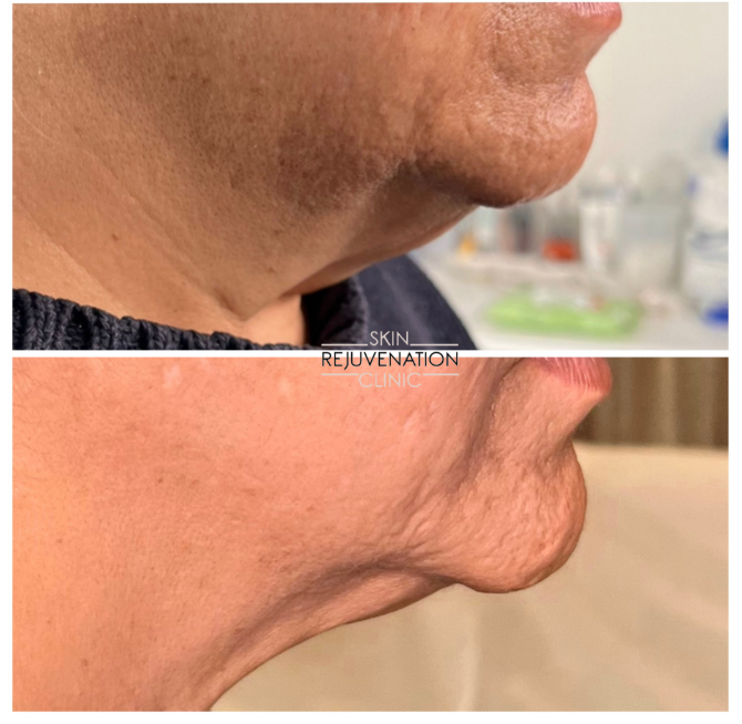 Treatment result