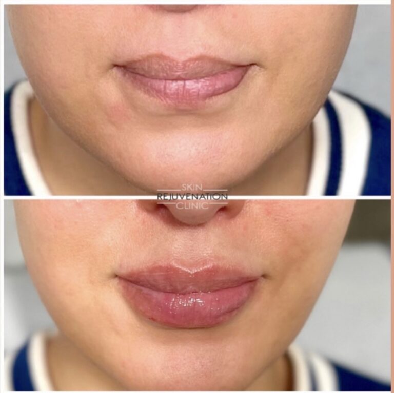 Treatment result