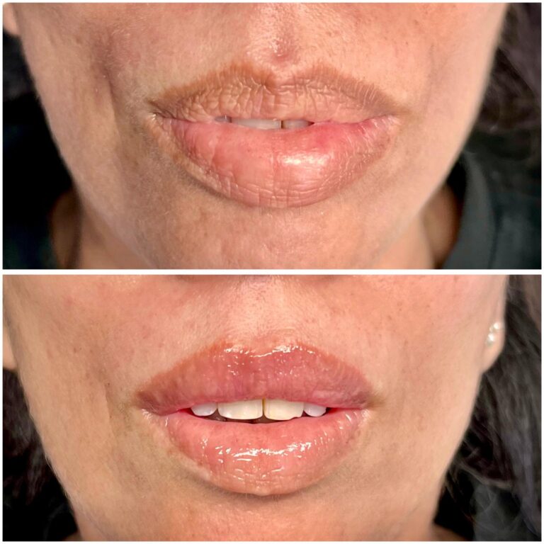 Treatment result