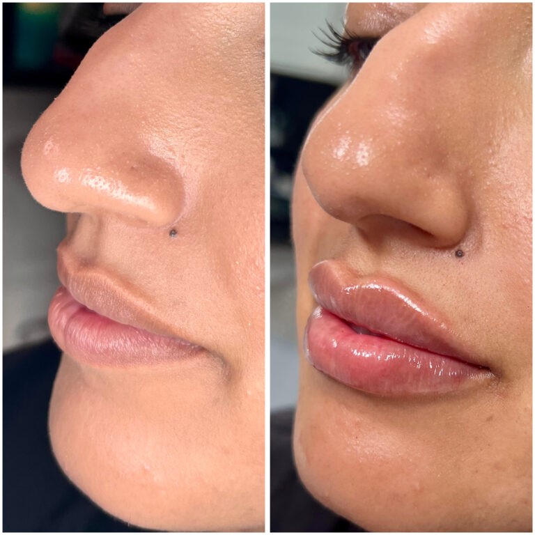 Treatment result