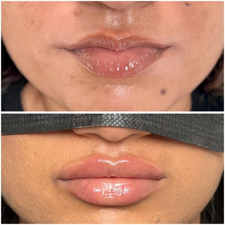Treatment result