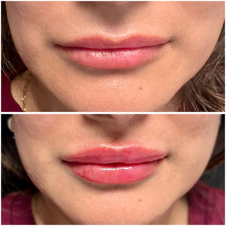 Treatment result