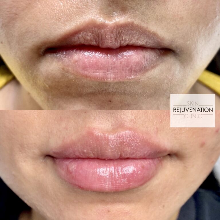 Treatment result