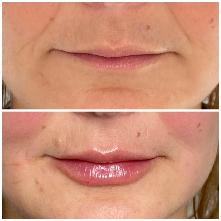 Treatment result