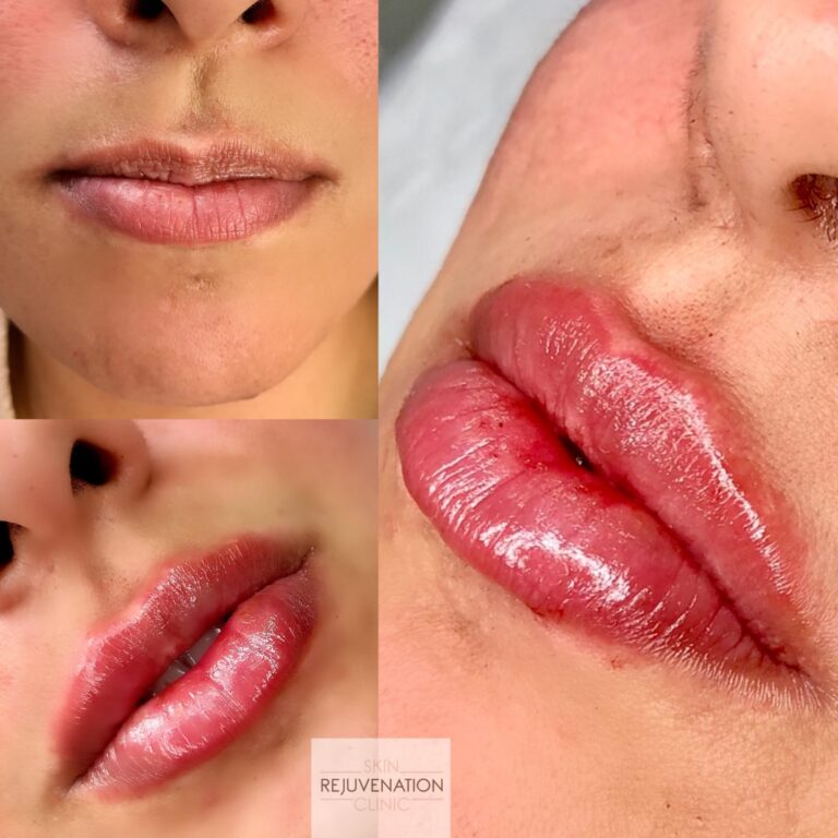 Treatment result