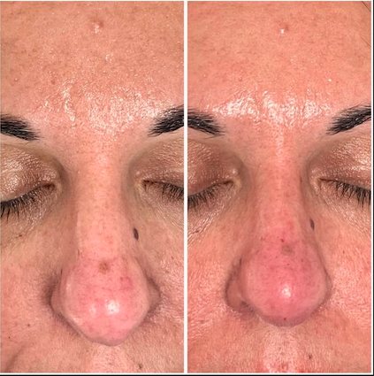 Treatment result
