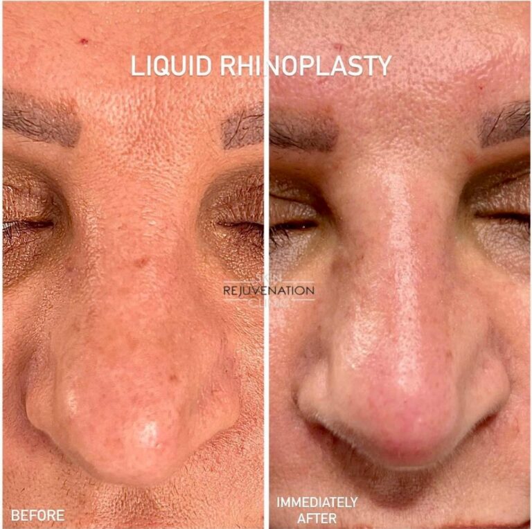 Treatment result