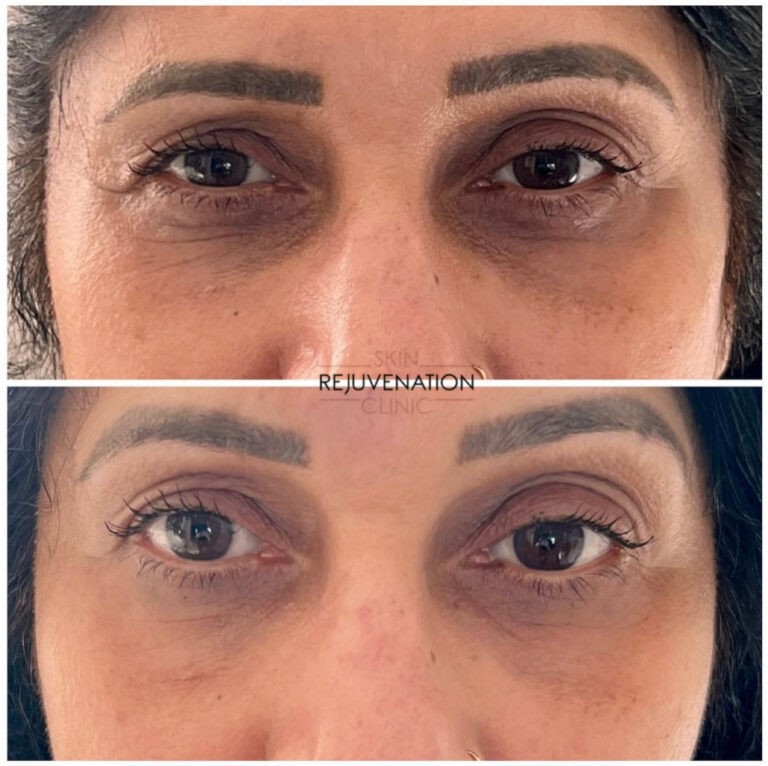 Treatment result