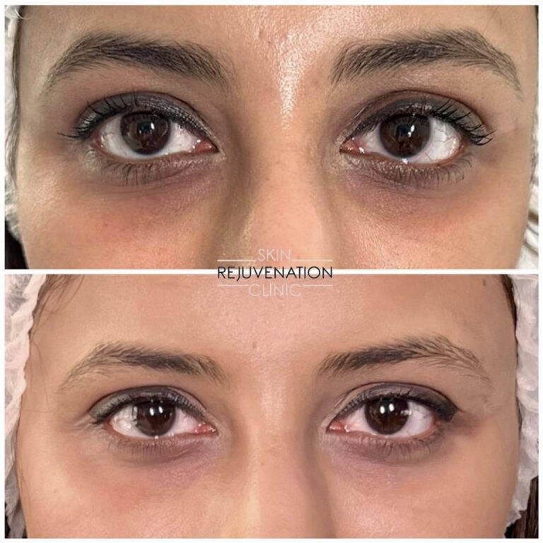 Treatment result