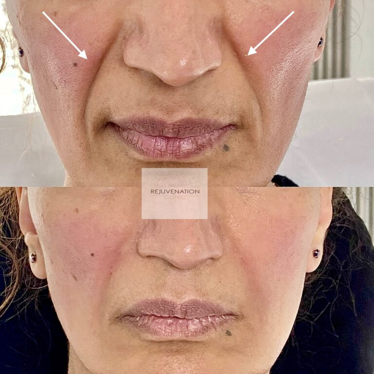 Treatment result