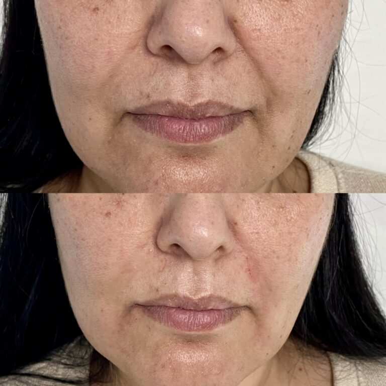 Treatment result