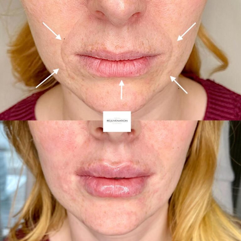 Treatment result