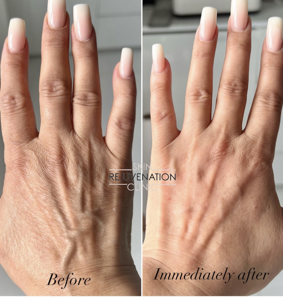 Treatment result