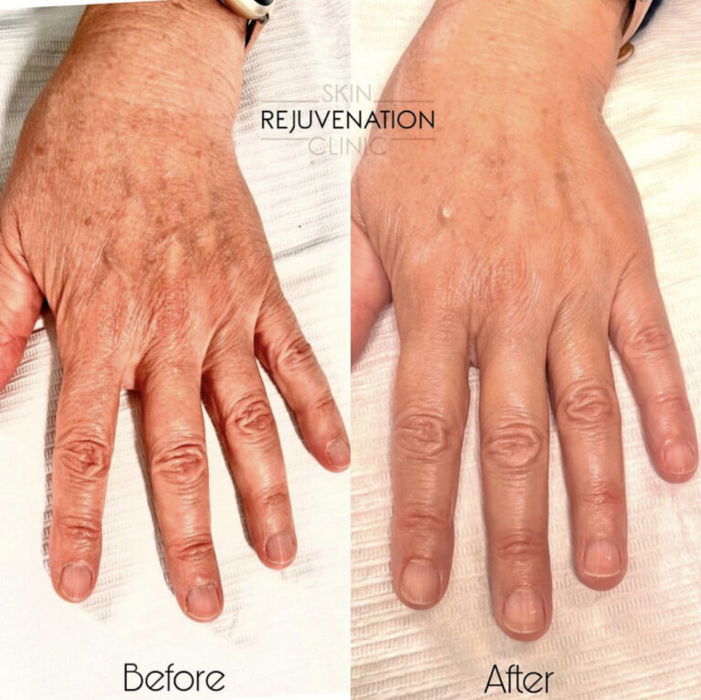 Treatment result
