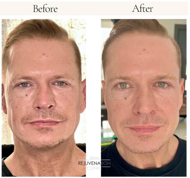 Treatment result