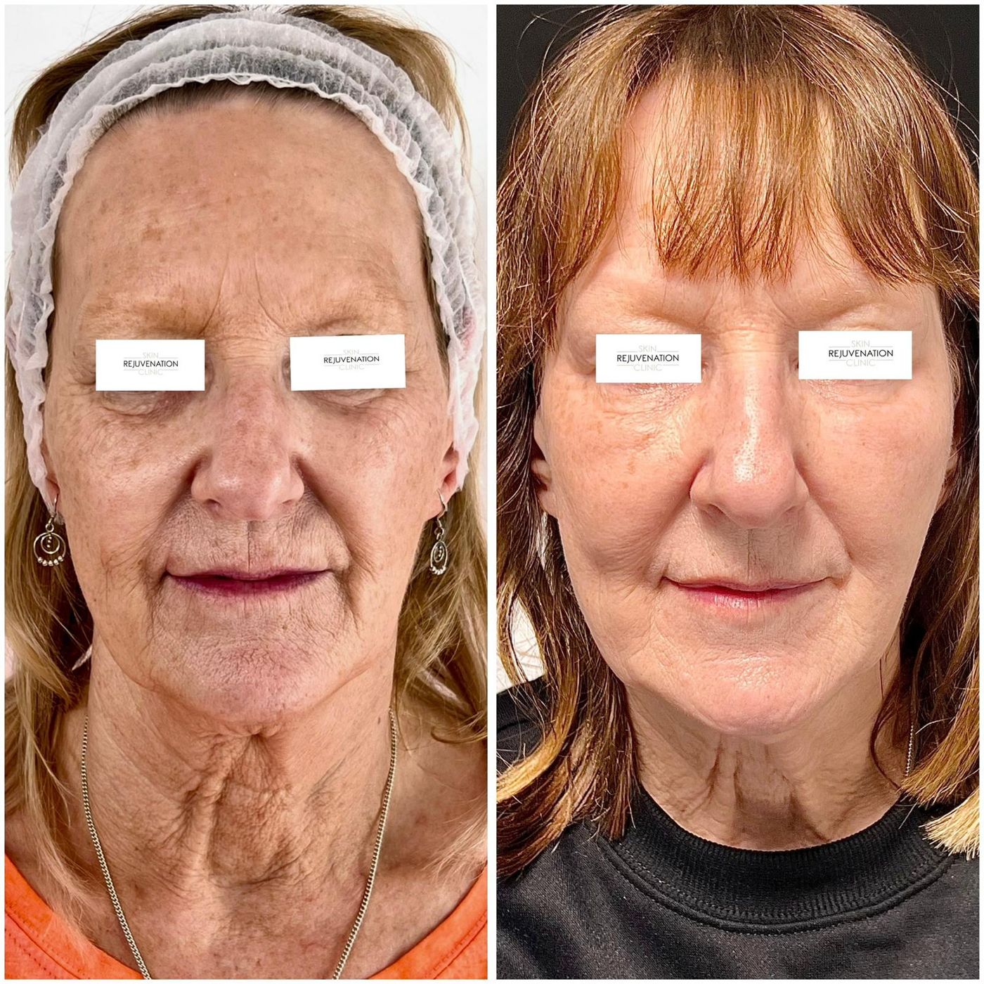 Skin booster before and after, full face