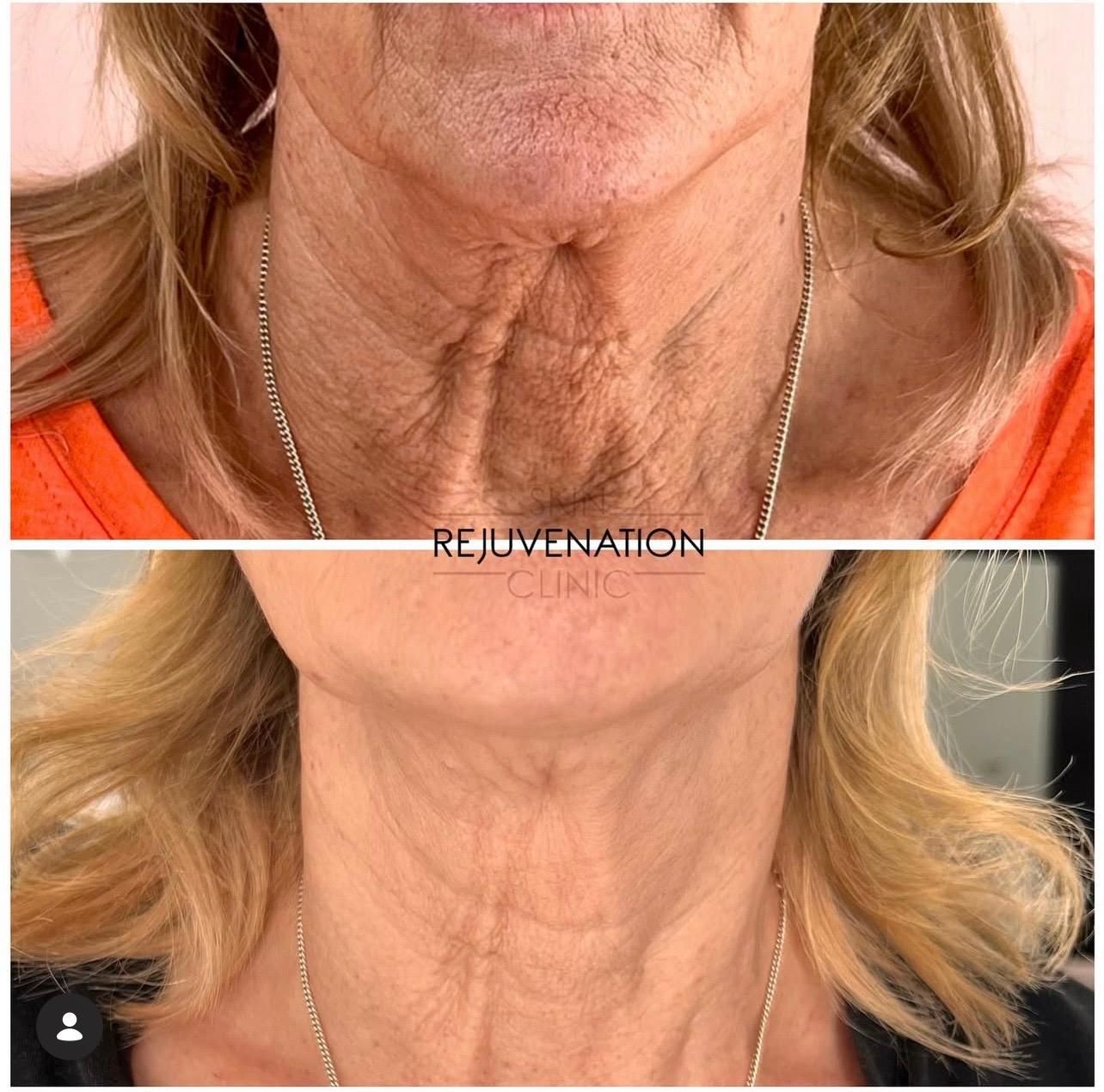 Skin booster before and after, neck and décolletage