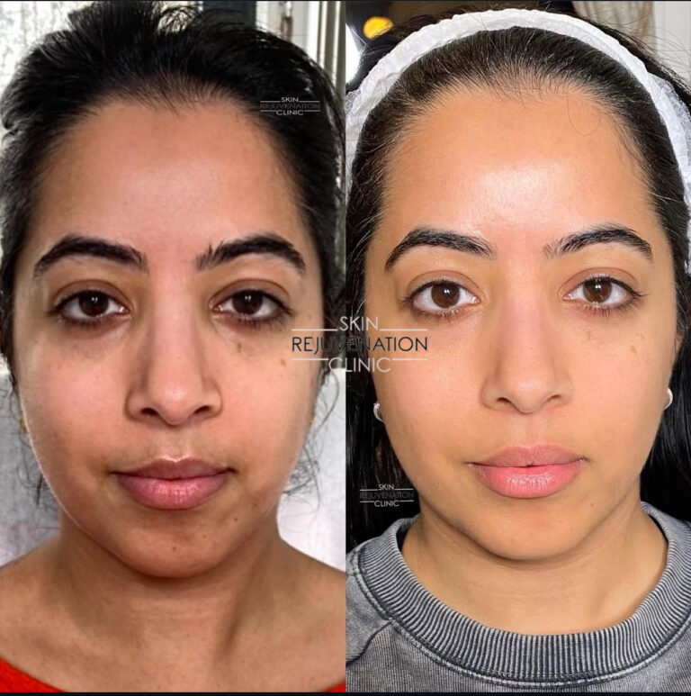 Treatment result