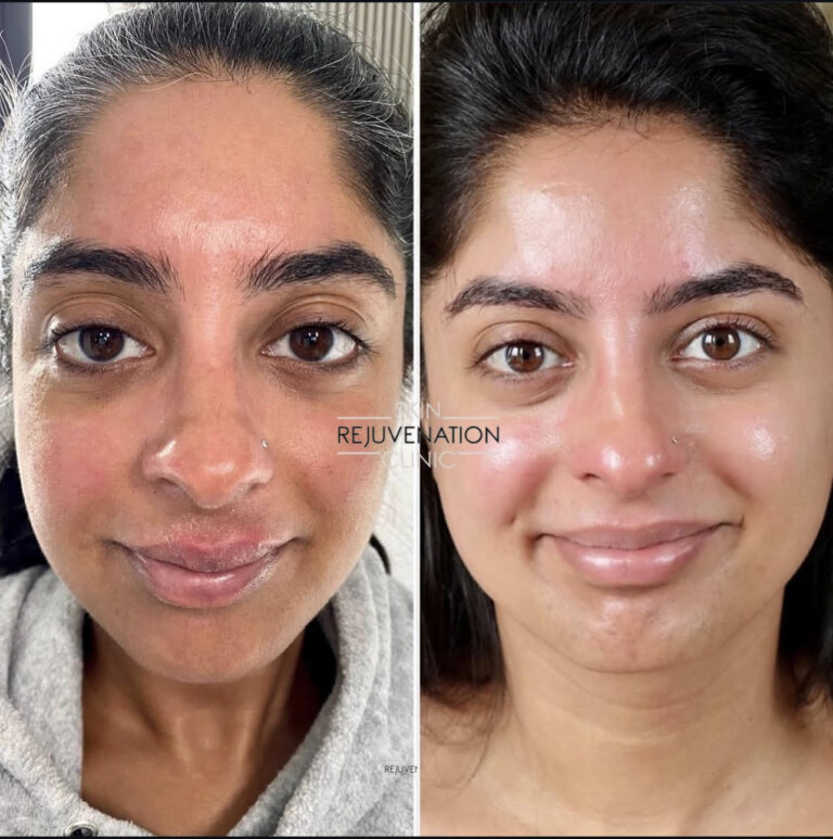 Treatment result