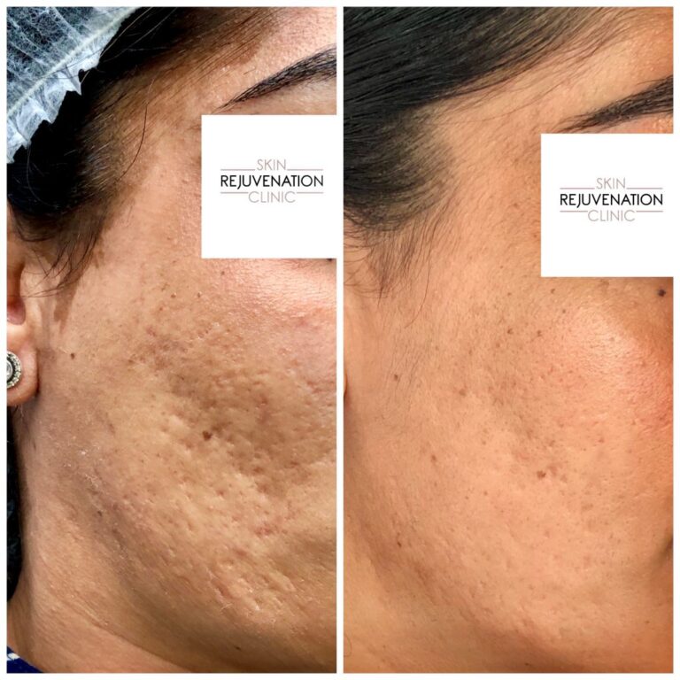 Treatment result