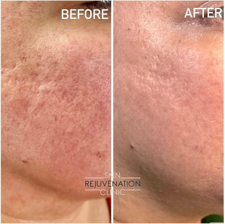 Treatment result