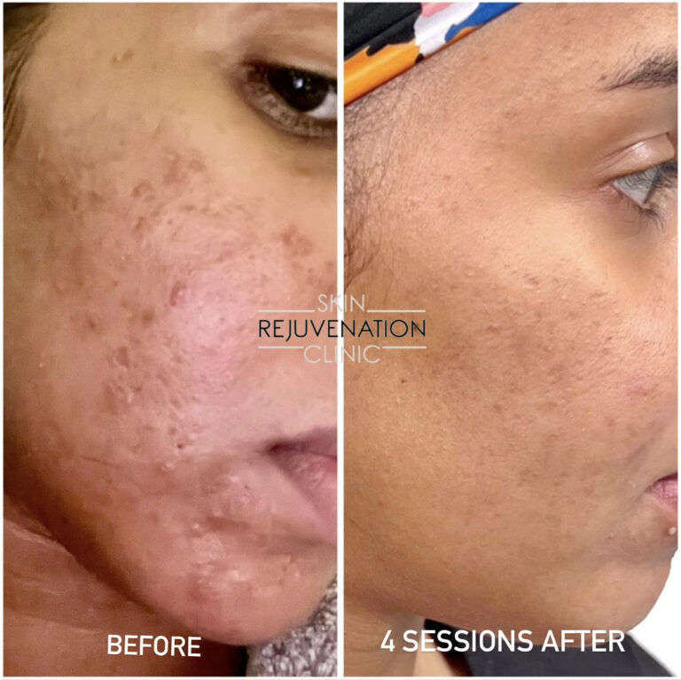 Treatment result