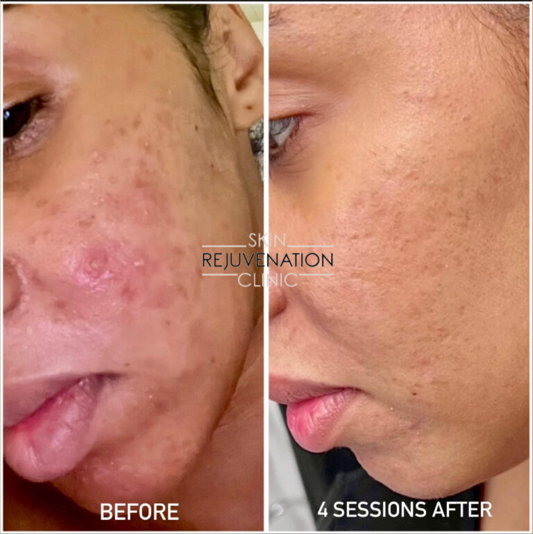 Treatment result