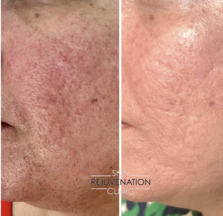 Treatment result