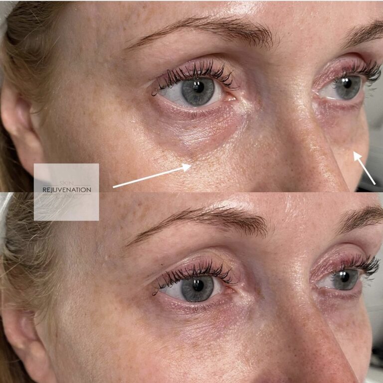 Treatment result