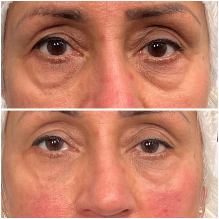 Treatment result