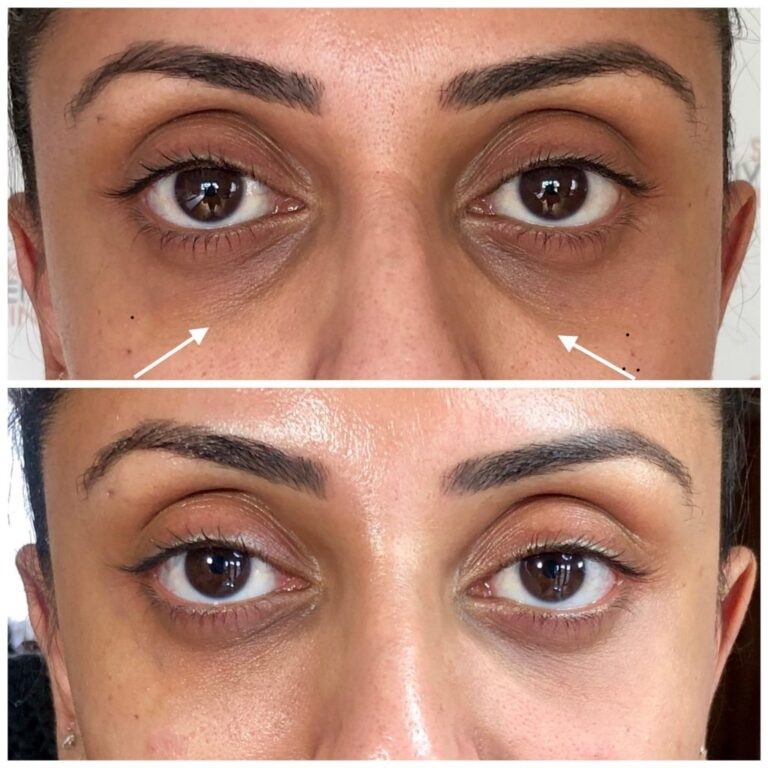 Treatment result