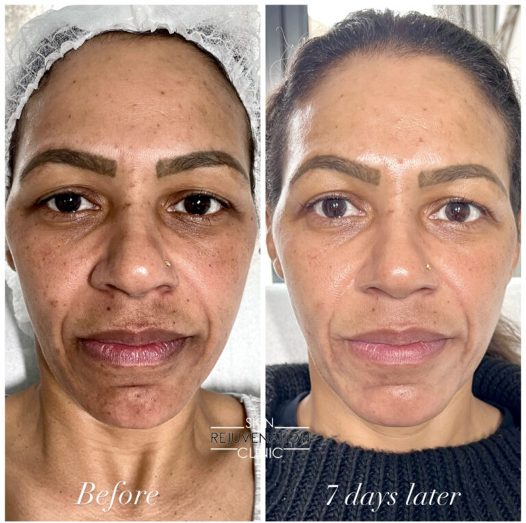 Treatment result