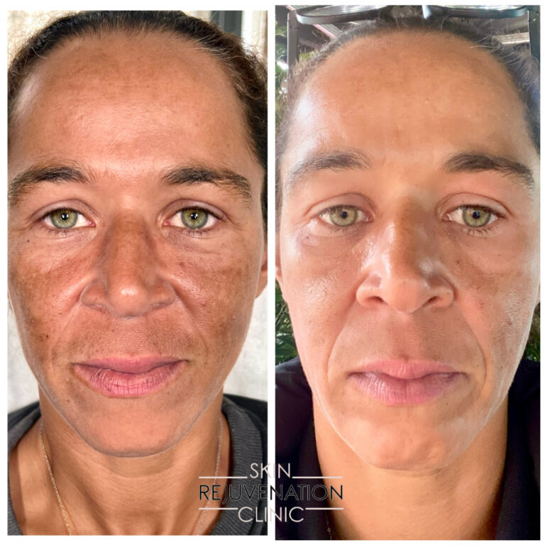 Treatment result