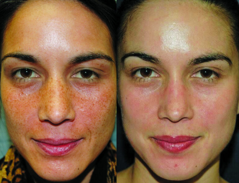 Treatment result