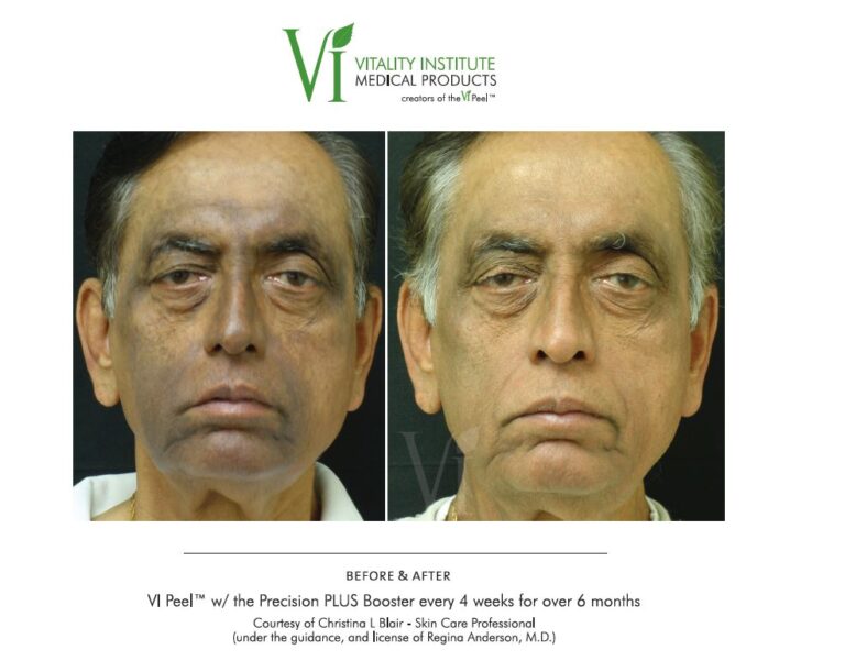 Treatment result