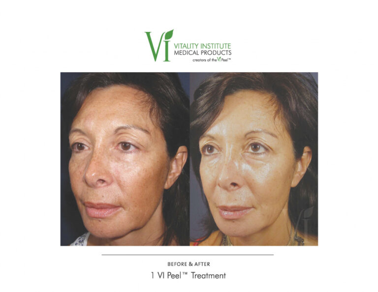 Treatment result